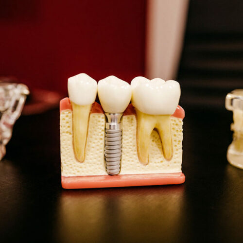 implantes-dentarios-01